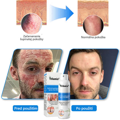 Oficiálny obchod: Trilumia®Horčíkový bylinný sprej na psoriázu⚕️certifikované FDA (úľava od psoriázy a ekzému, zlepšenie bakteriálnych infekcií v oblasti genitálií a liečba akné a tmavých škvŕn)